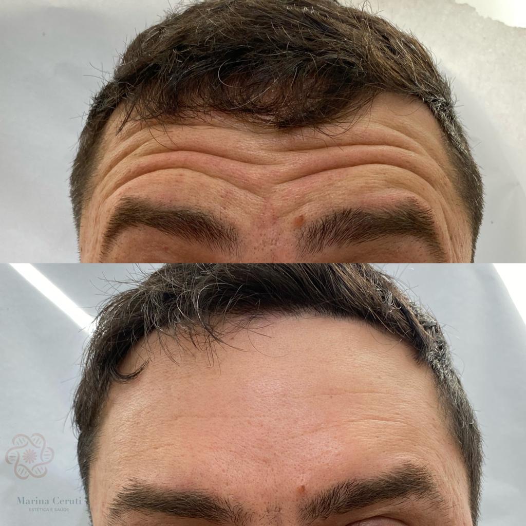 Botox para Homens: Áreas de Aplicação e Expectativas