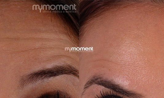 Botox Preventivo: Quando Começar e Quais os Benefícios