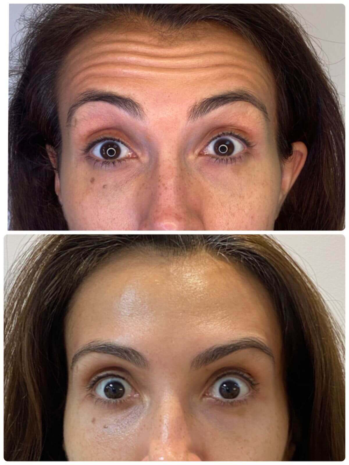 Botox Preventivo: Quando Começar e Quais os Benefícios