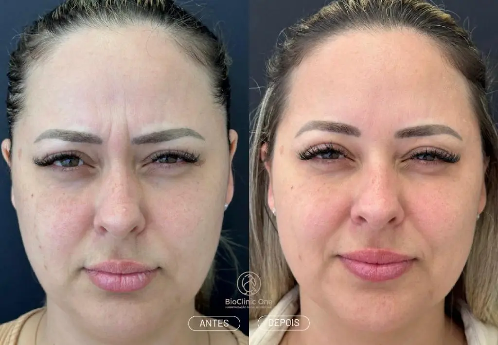 Mitos e Verdades sobre a Aplicação de Botox