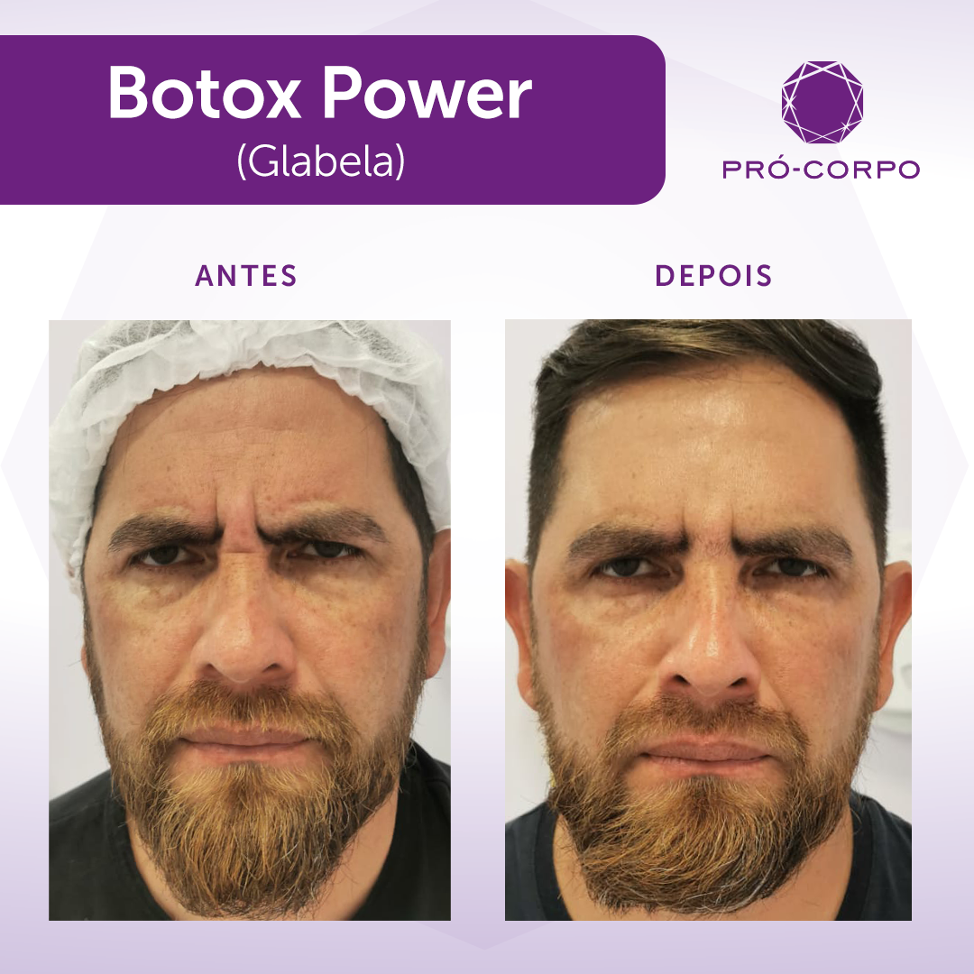 botox antes depois