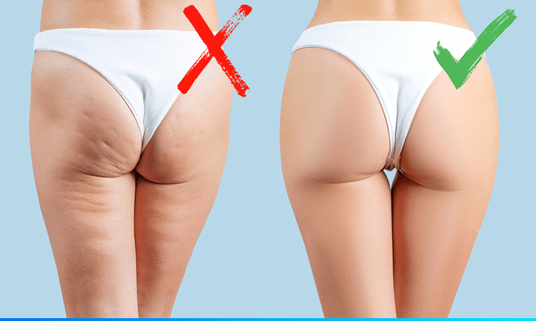 rotina de beleza para diminuir celulite