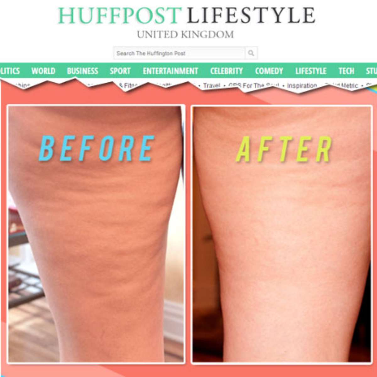 erros comuns que pioram a celulite