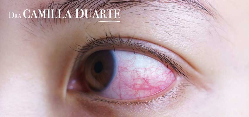 Guia Completo dos Tratamentos para Cílios Invertidos: Do Simples à Cirurgia