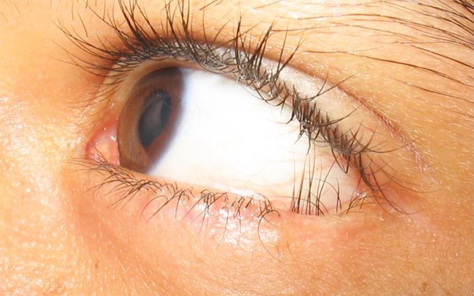 Cílios Ectópicos: O Que São e Por Que Eles Nascem em Lugares Anormais