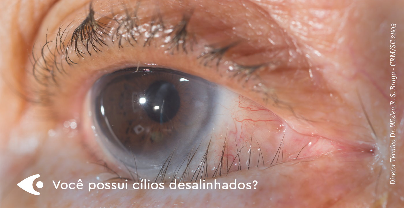 Sintomas de Cílios Invertidos: Quando Procurar um Oftalmologista Urgente