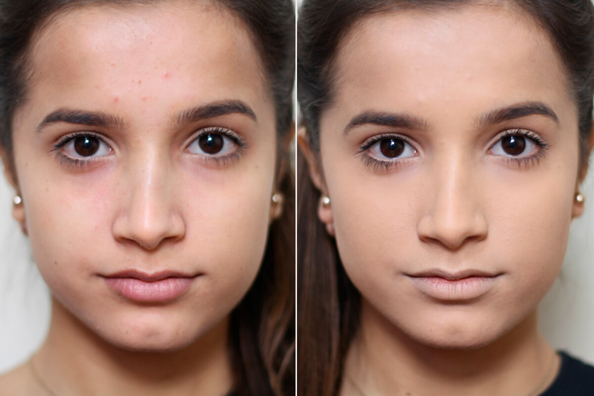 Rotina de Skincare para Pele Oleosa: Preparando para o Efeito Matte