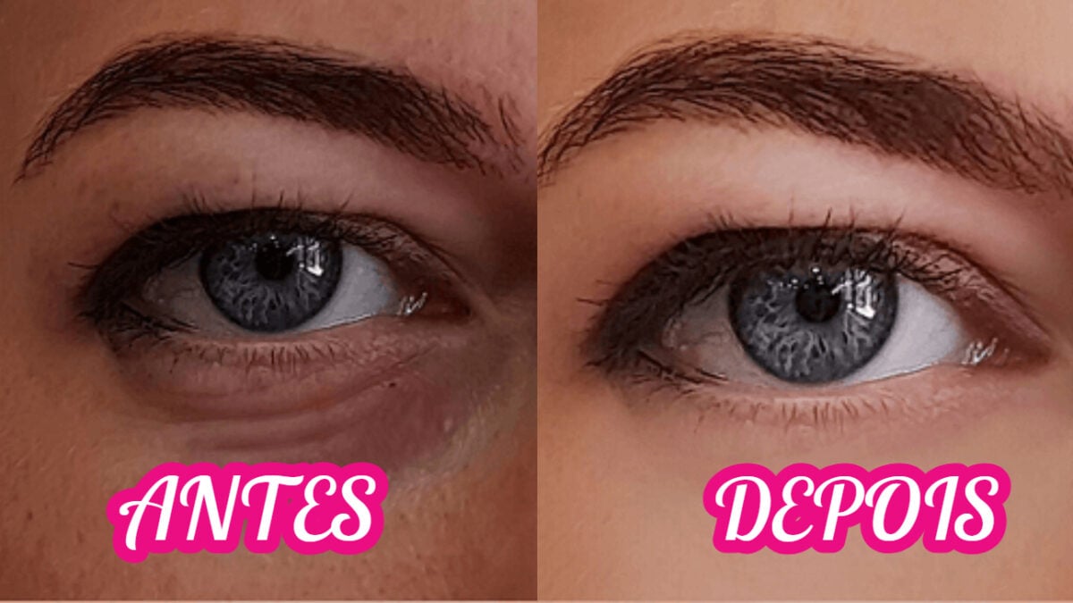 Bepantol para Olheiras: Mitos e Verdades sobre a Hidratação da Área dos Olhos