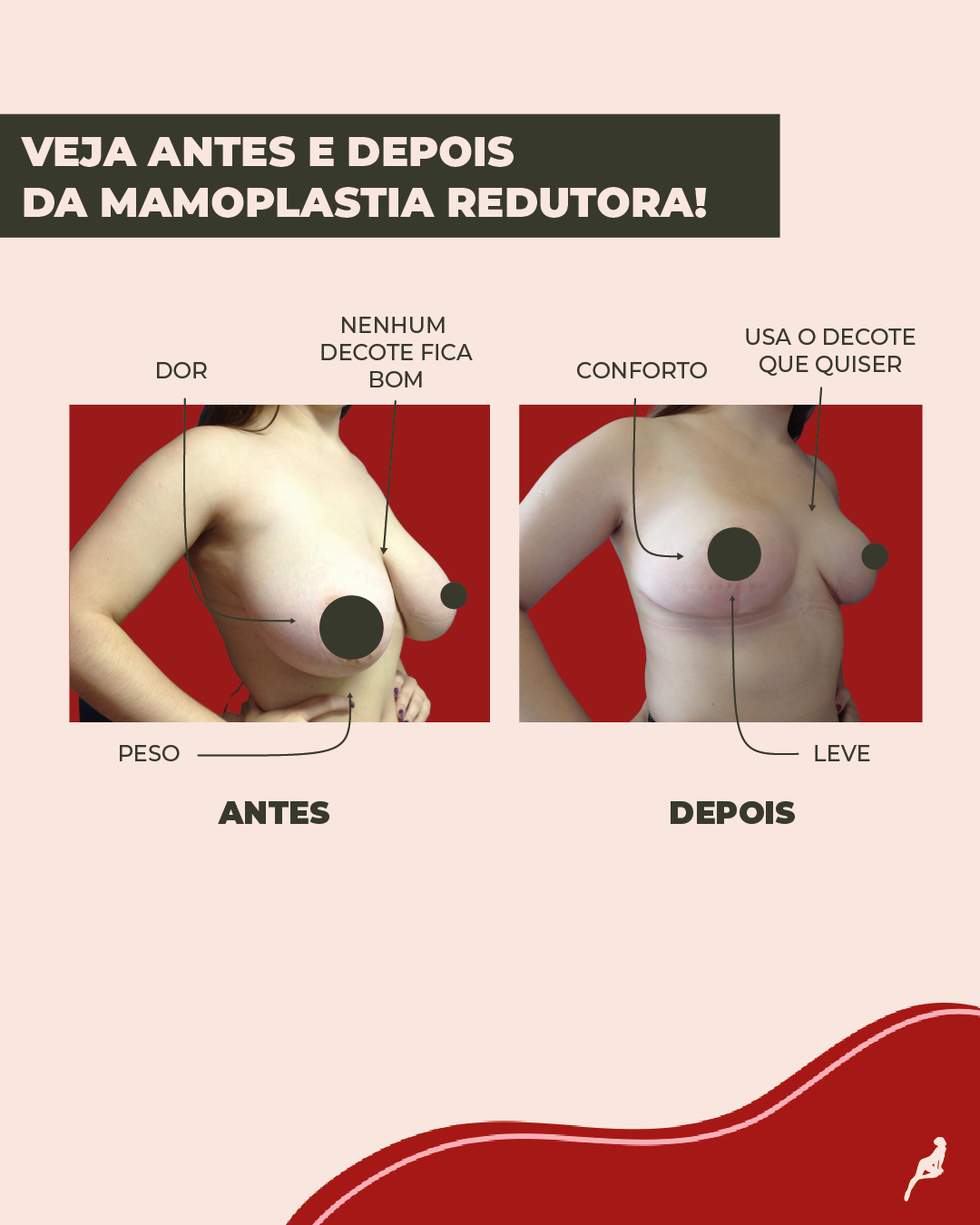 Como Lidar com Dores na Coluna Causadas pelo Peso das Mamas