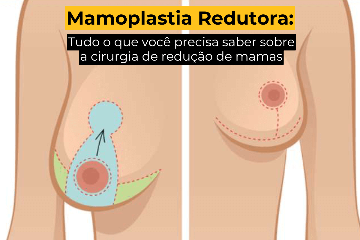 como fazer redução de mama pelo sus