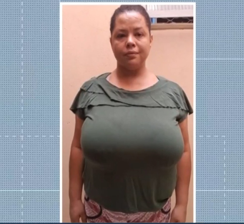 Entenda a Gigantomastia: Causas e Sintomas