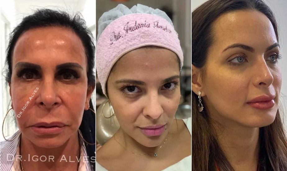 Os Melhores Iluminadores e Corretivos para Disfarçar o Bigode Chinês