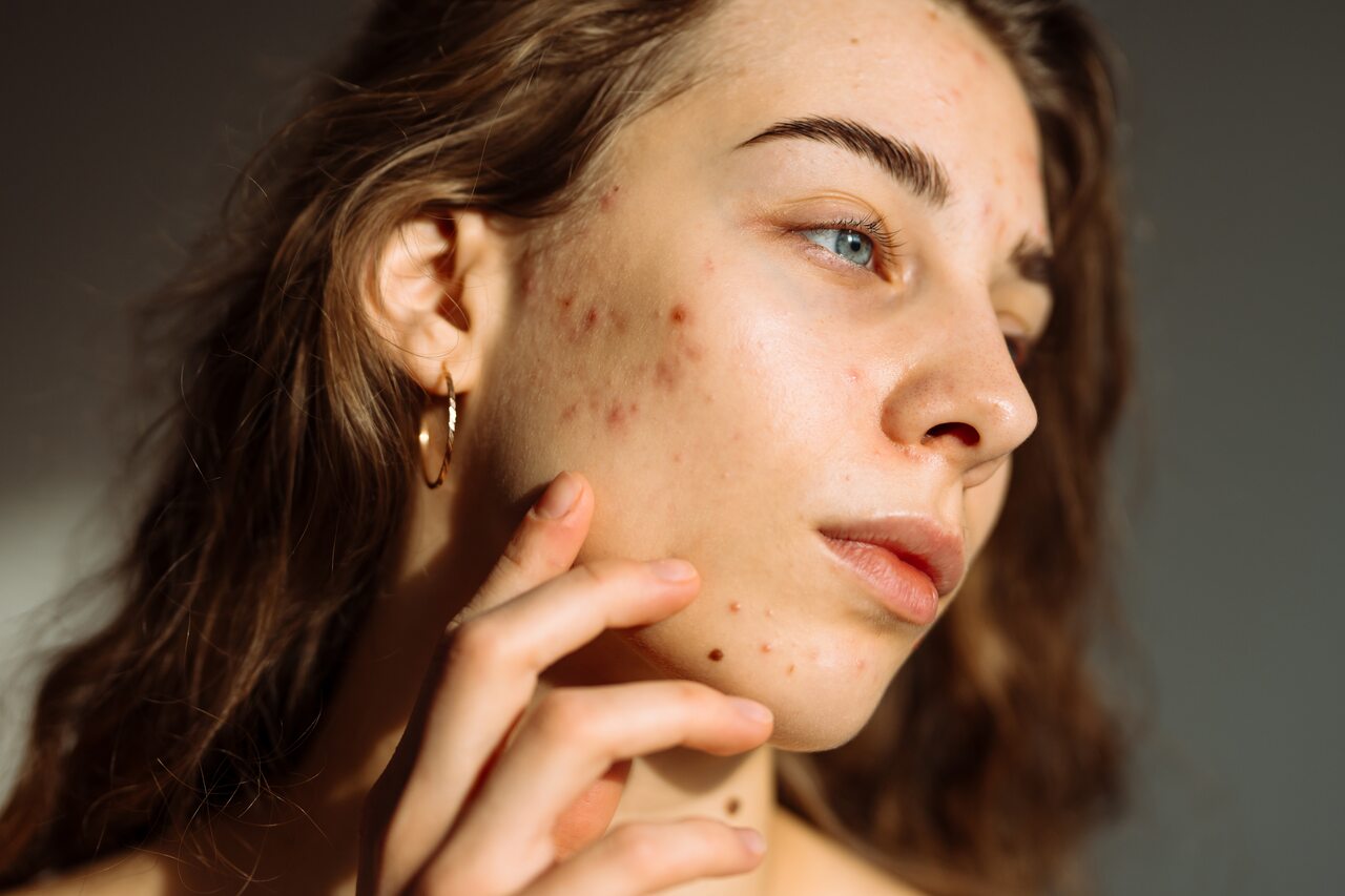 Guia Completo de Skincare para Pele Oleosa e Acneica