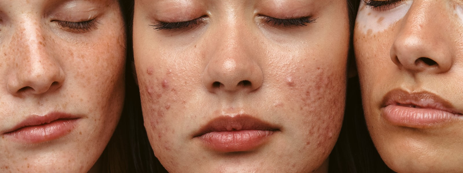 Espinhas Internas: Causas