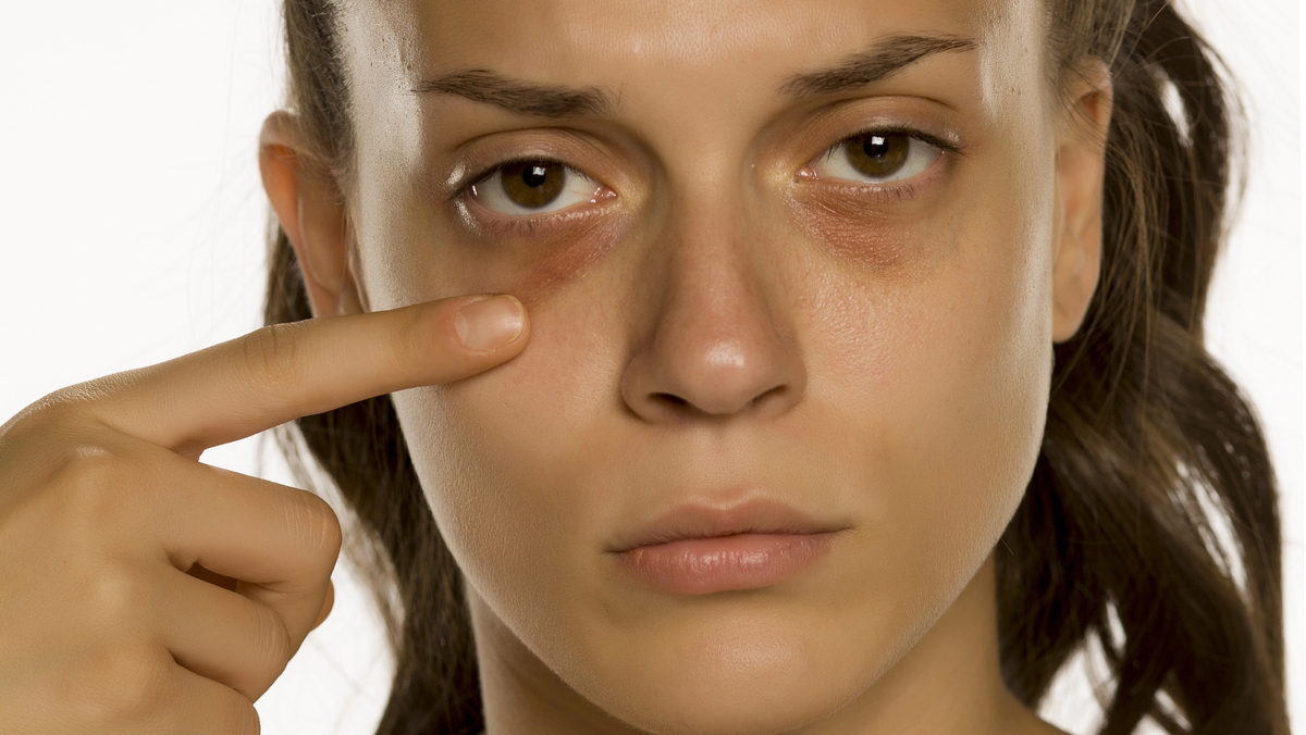 remédio caseiro para olheiras