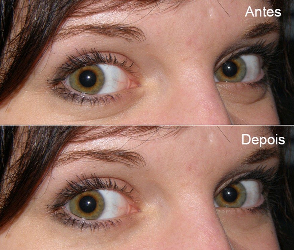 cirurgia para olheiras