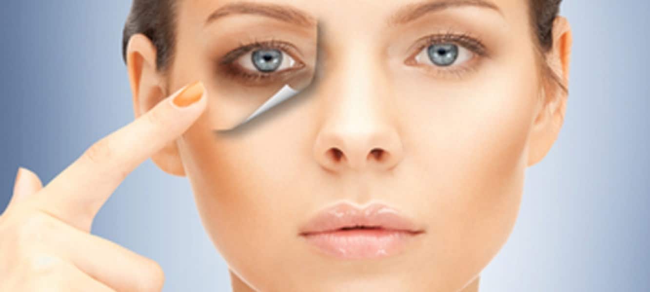 Como a Rinite Afeta Suas Olheiras e o que Fazer para Aliviar