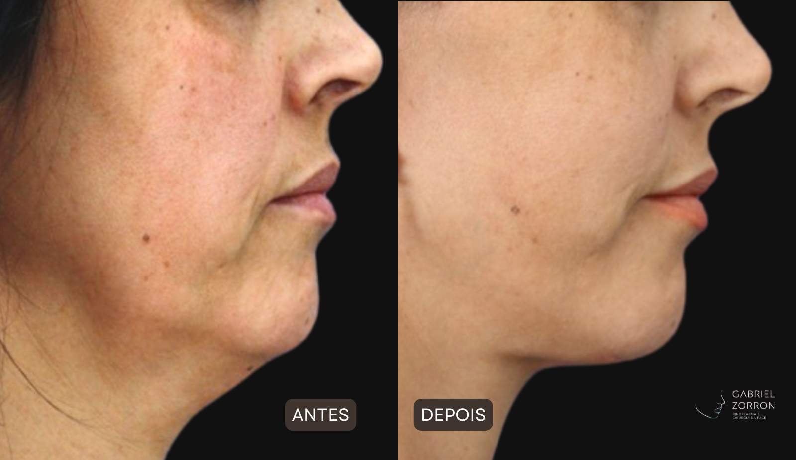 Lifting facial não cirúrgico valor