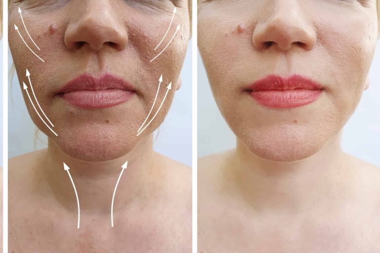 melhores tecnologias lifting facial não cirúrgico