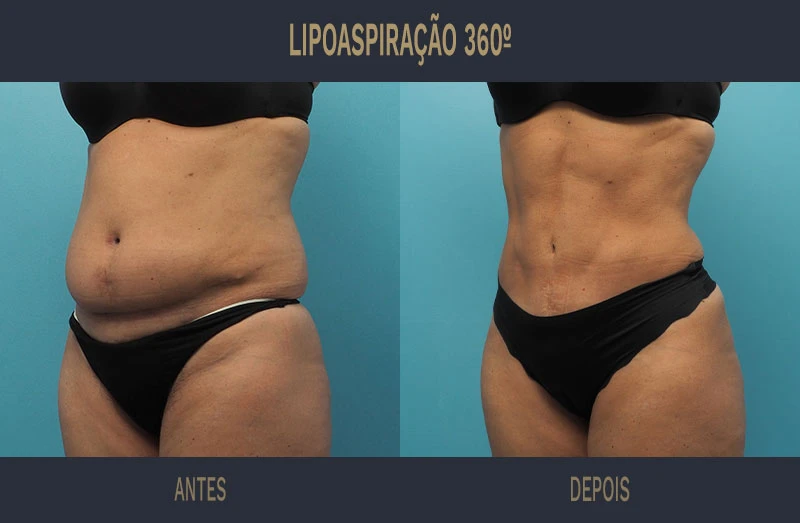 erros comuns ao escolher cirurgião para lipoaspiração