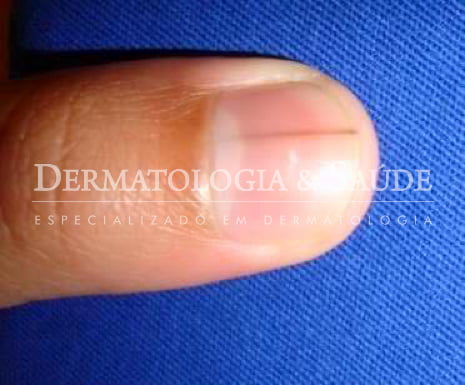 listra escura na unha