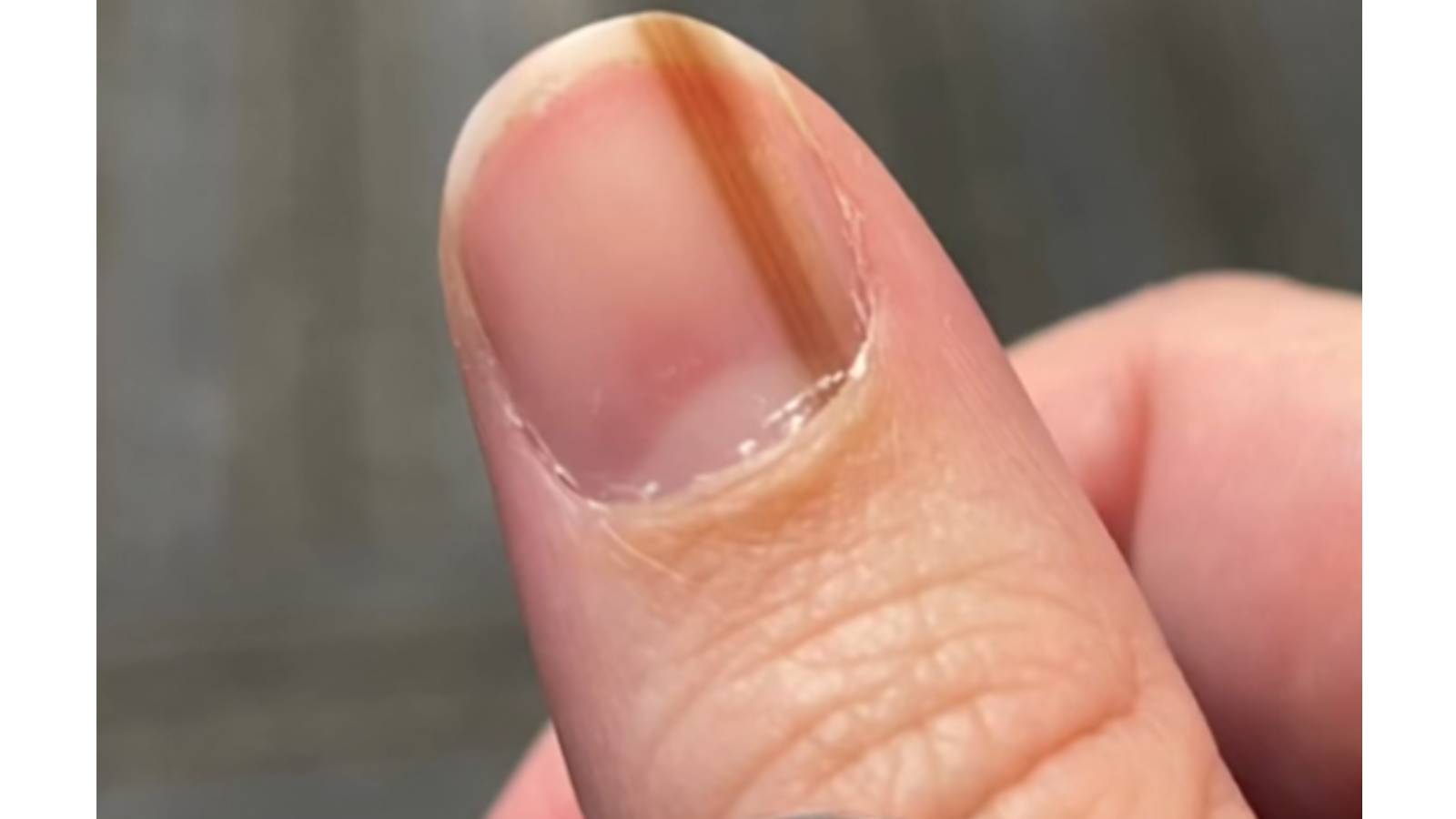 Como identificar deficiências vitamínicas pelas unhas