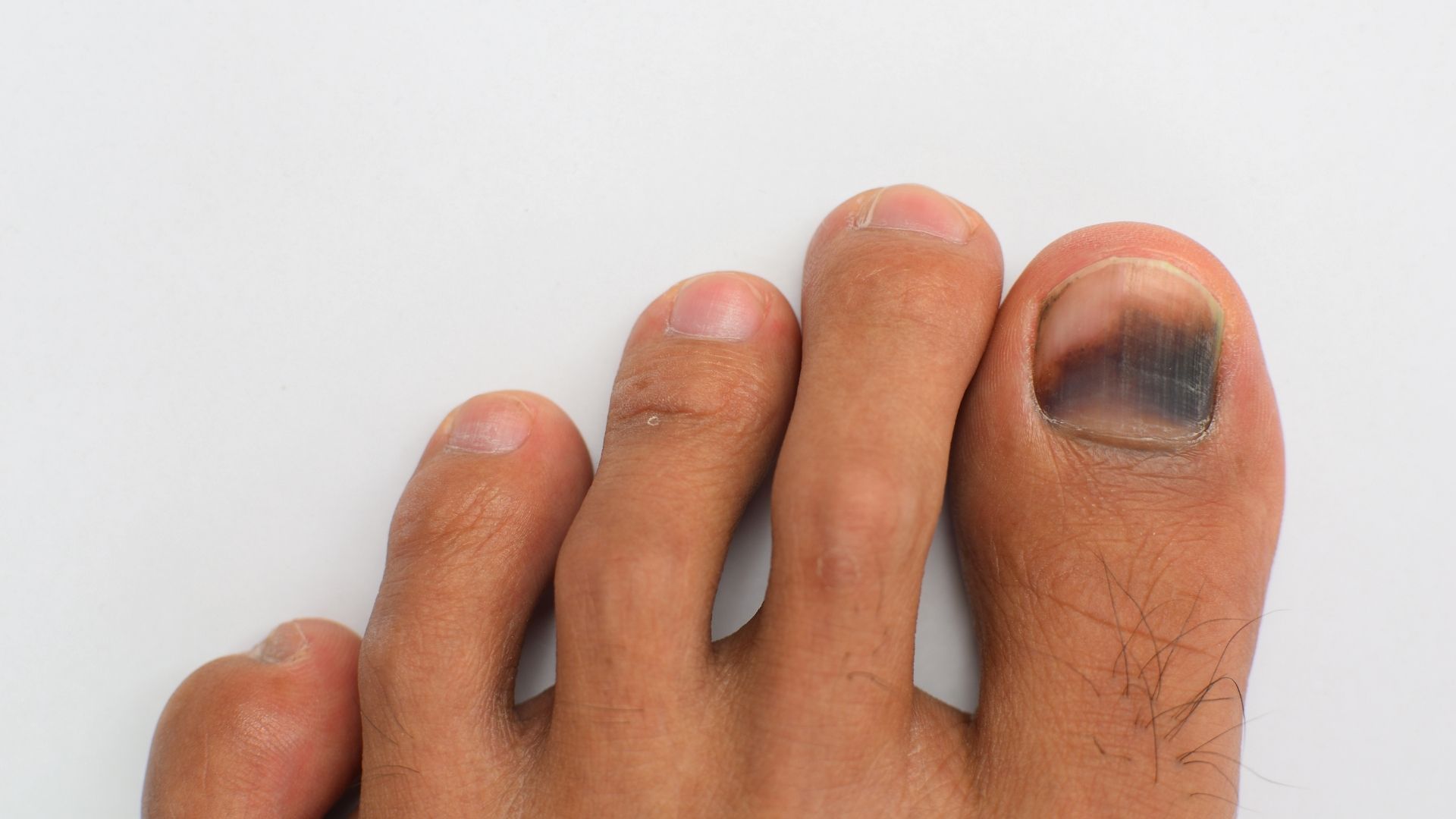 Unhas estriadas: quando é normal e quando procurar ajuda médica