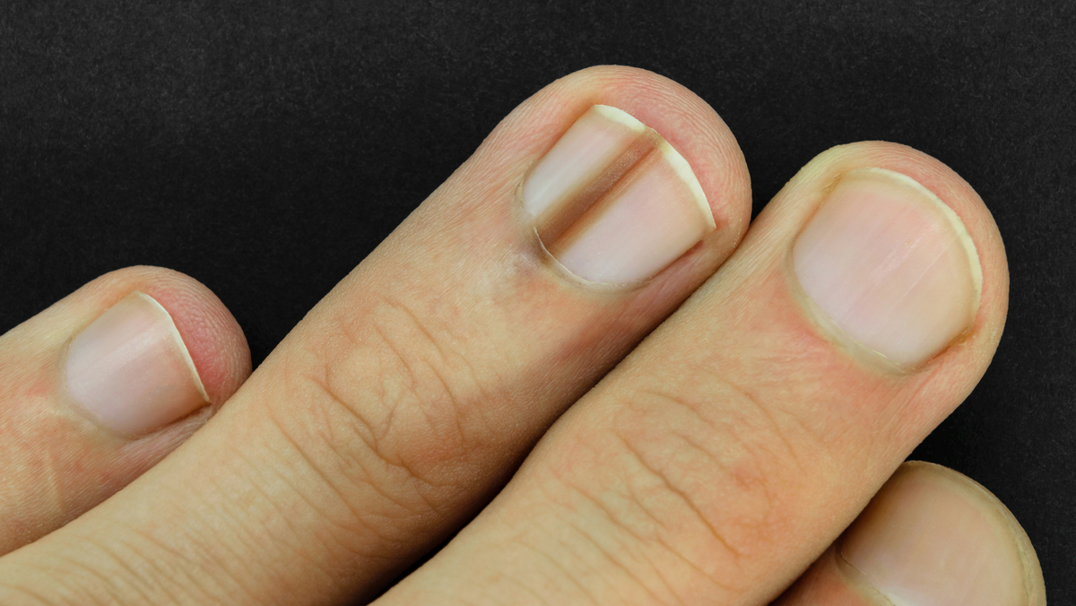 Cuidados com as unhas para evitar traumas e listras