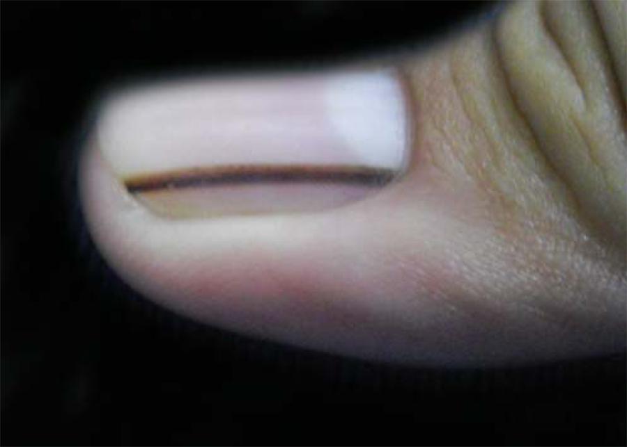 Melanoma subungueal: sinais de alerta e prevenção