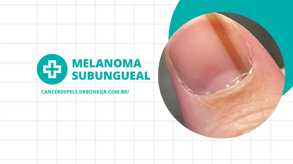 Cuidados com as unhas para evitar traumas e listras