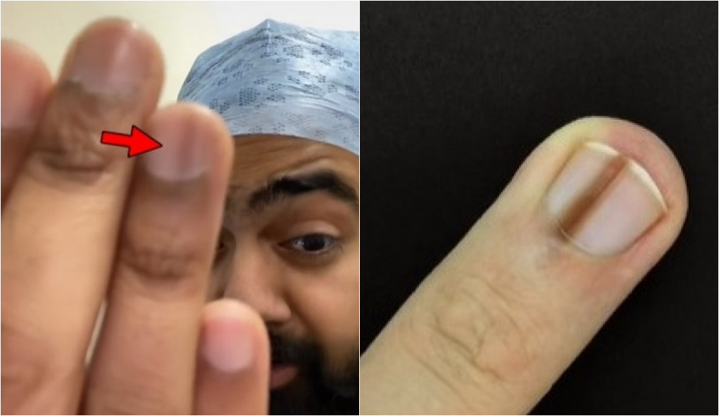 A importância da dermatoscopia no diagnóstico de lesões ungueais