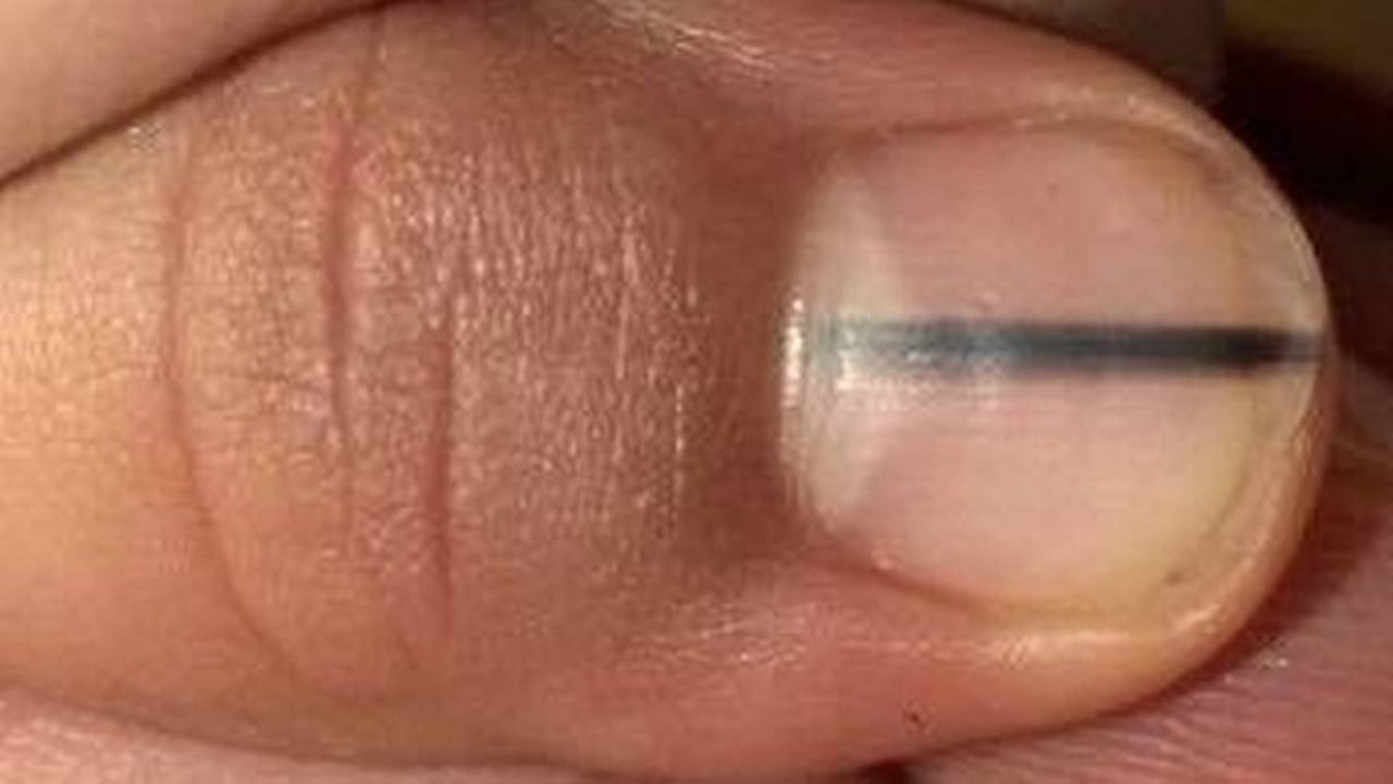 Cuidados com as unhas para evitar traumas e listras