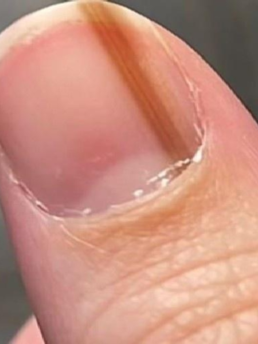 Unhas estriadas: quando é normal e quando procurar ajuda médica