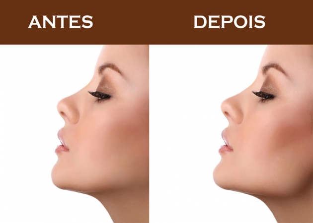 Os Segredos da Harmonização Facial para Maçãs do Rosto Perfeitas