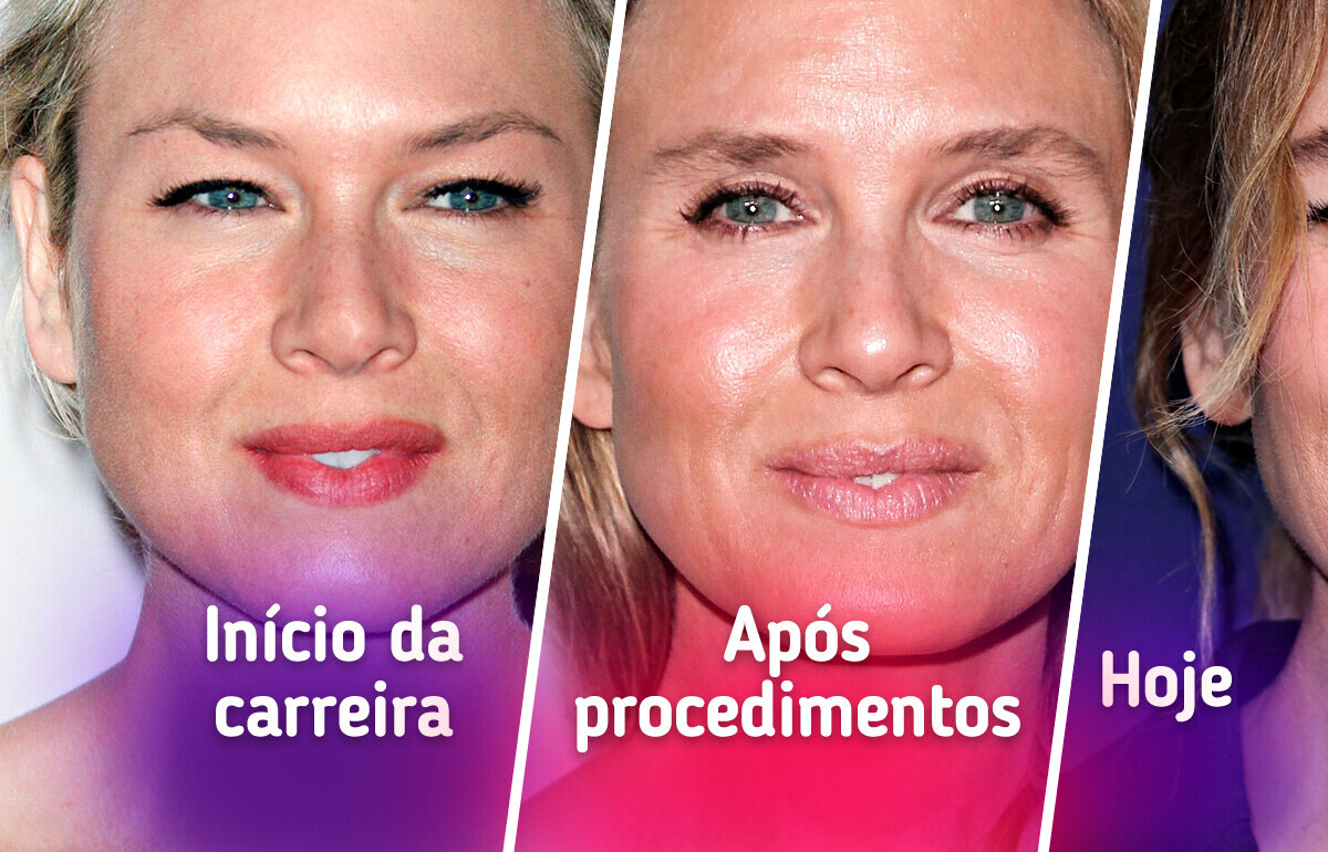 Entendendo o Osso Zigomático e sua Importância para a Estrutura Facial