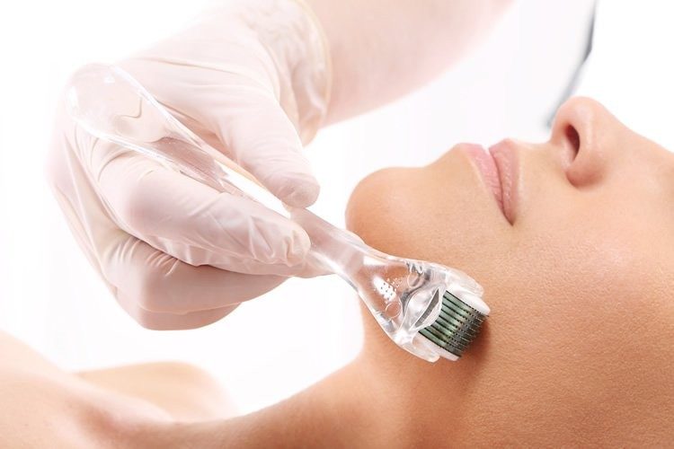 Microagulhamento para Cicatrizes de Acne: Guia Completo e Resultados