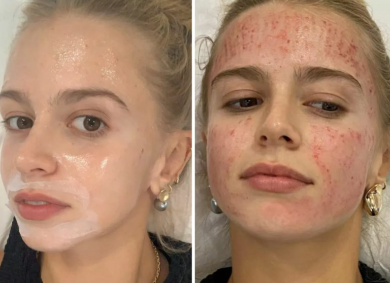 Dermaroller vs. Dermapen: Qual o Melhor para Sua Pele?