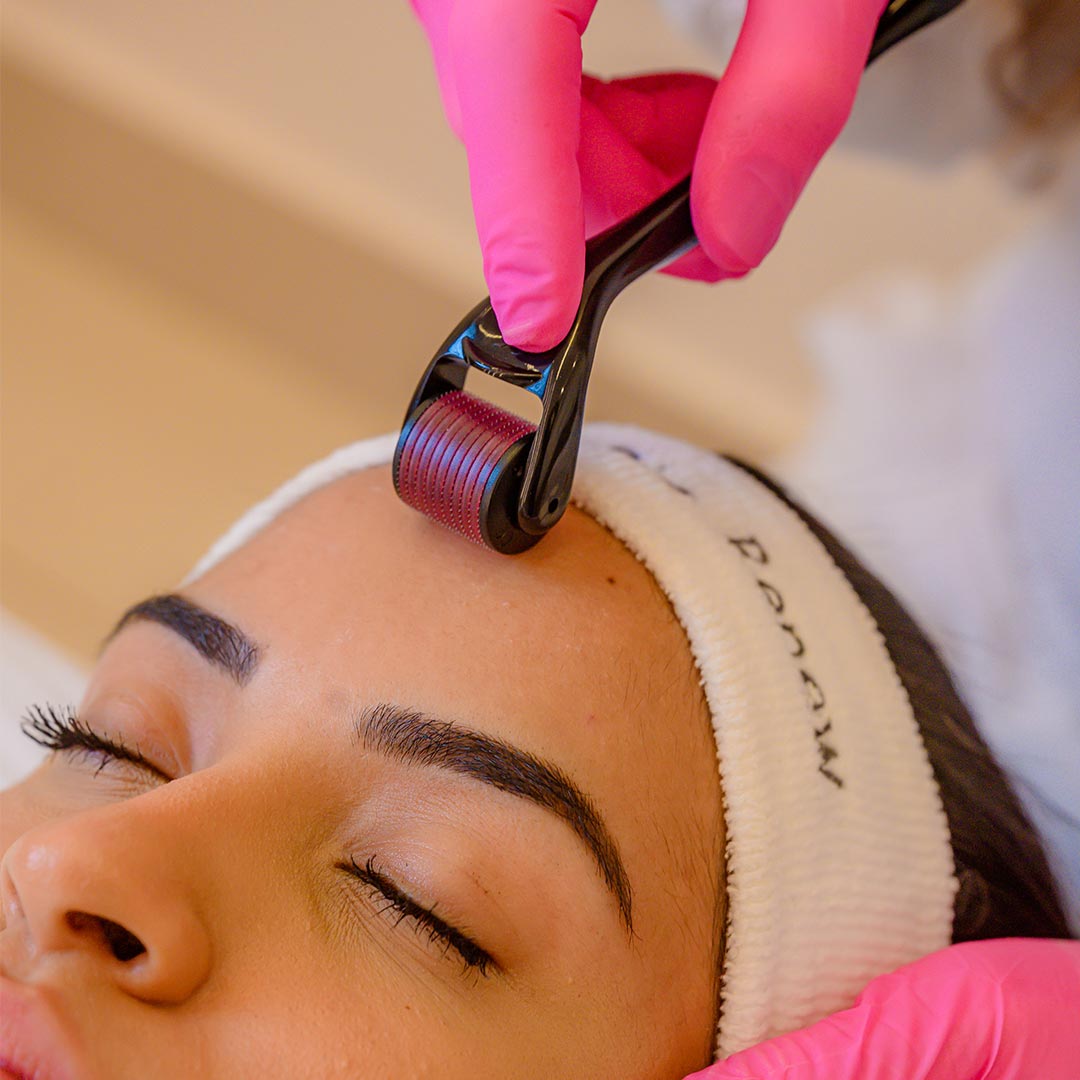 Como o Microagulhamento Ajuda no Tratamento de Melasma e Queda de Cabelo