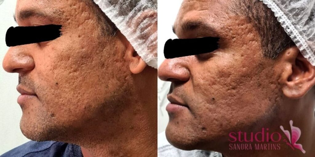 Microagulhamento: Mitos e Verdades sobre o Procedimento Estético