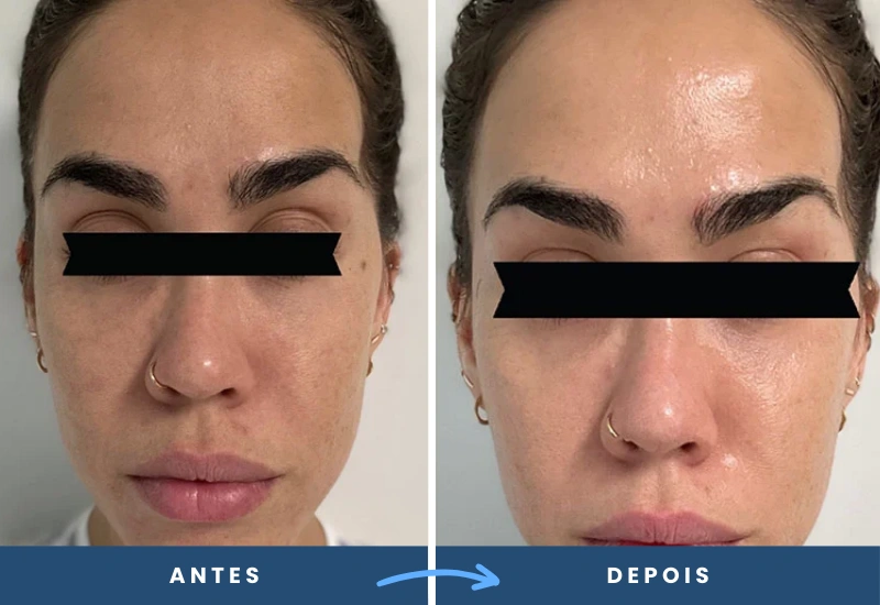 Dermaroller vs. Dermapen: Qual o Melhor para Sua Pele?