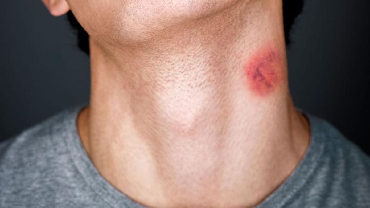 erros comuns ao tentar remover chupão do pescoço