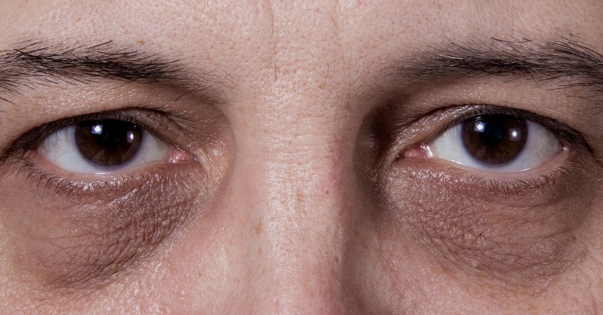 ácido hialurônico olheiras