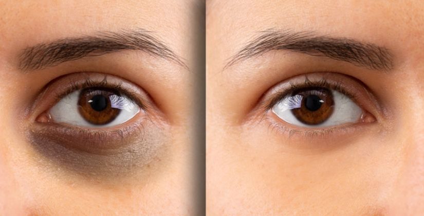 como clarear olheiras