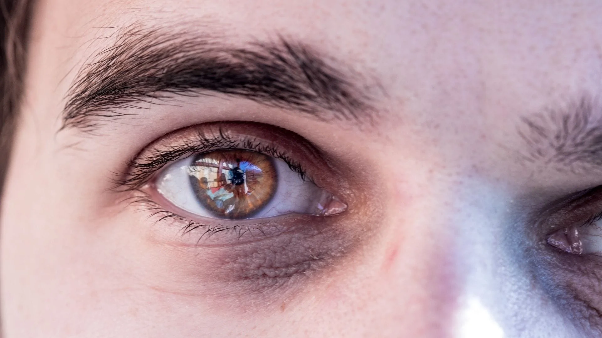 olheiras acastanhada