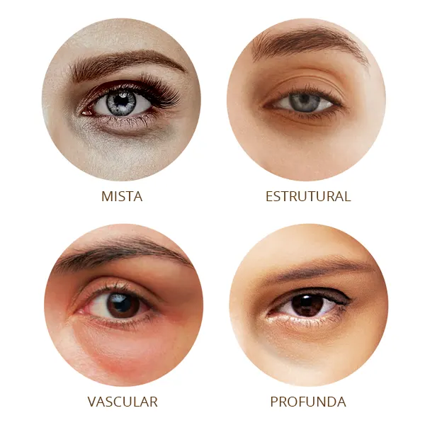 tratamento para olheiras