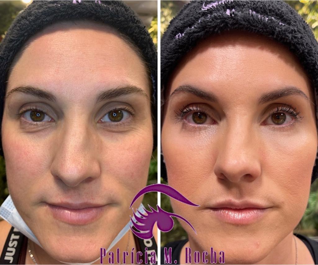 Cremes para Olheiras: Os Ativos Mais Eficazes para Clarear a Pálpebra