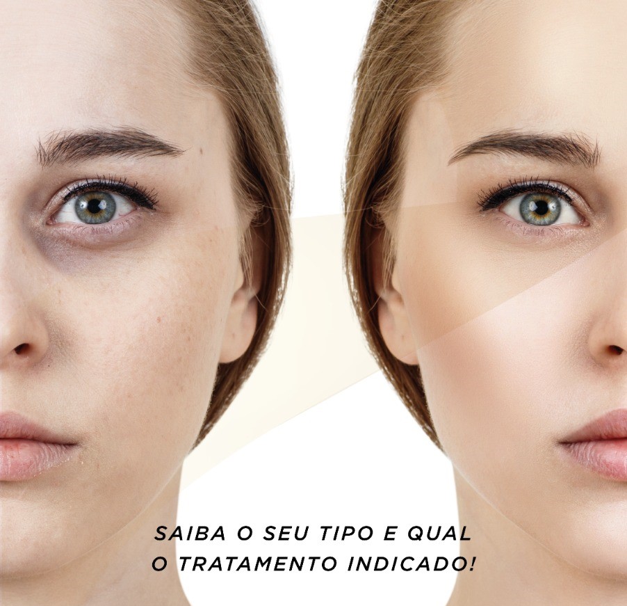 Guia Completo: Identifique o Tipo da Sua Olheira e Escolha o Tratamento Ideal