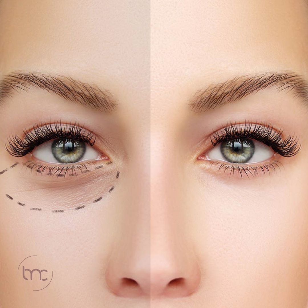 Desvendando os Cuidados Caseiros: Como Reduzir Olheiras Naturalmente