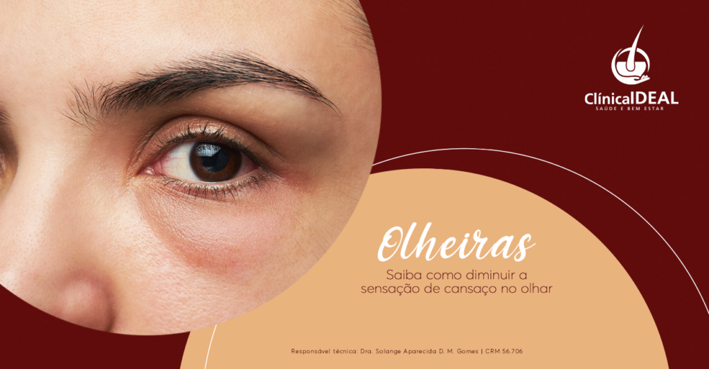 Ácido Hialurônico e Laser: Soluções Avançadas para Olheiras Profundas e Escuras