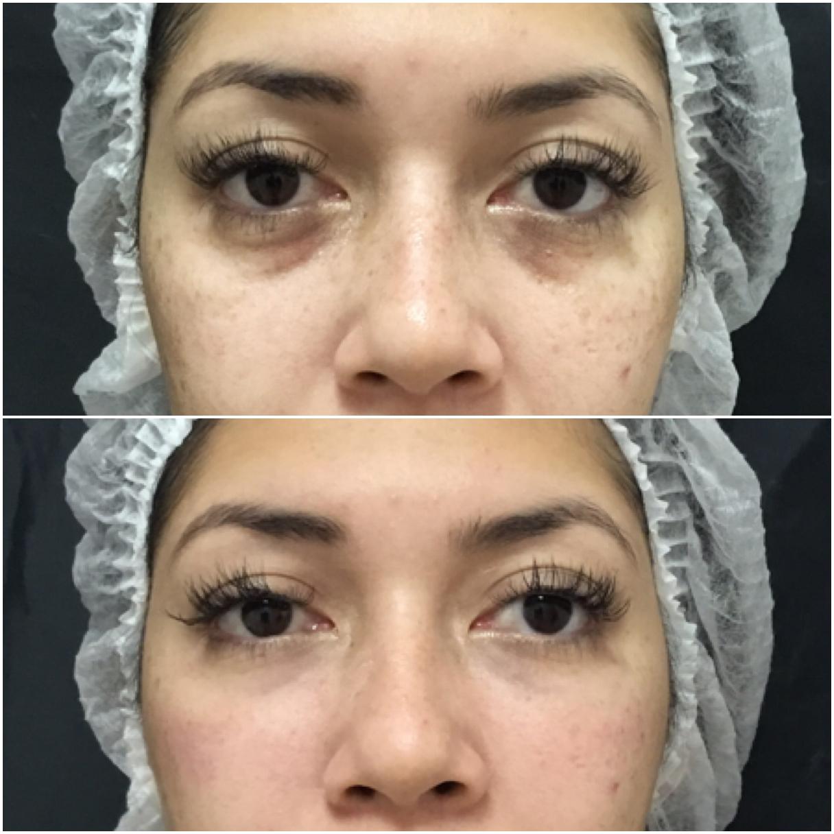 Procedimentos Estéticos para Olheiras: Qual o Mais Indicado para Você?